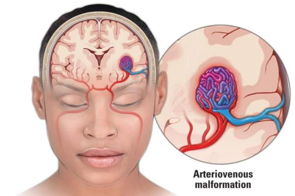 What Is AVM and Why Embolization Matters